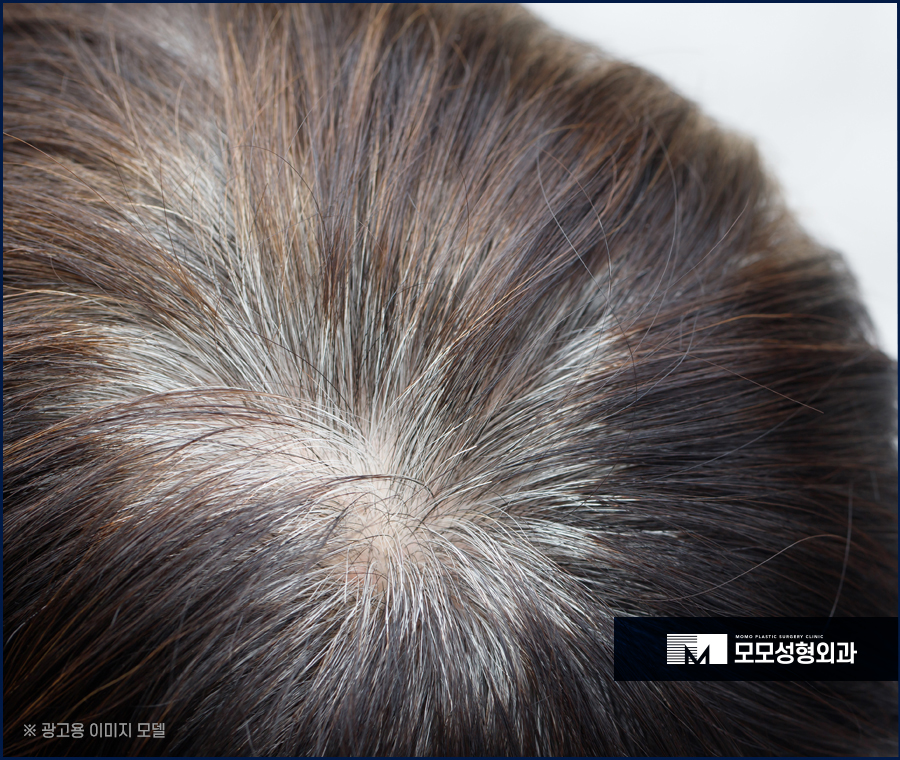 모발이식 재수술 실수가 다시 나타나지 않는 방향으로 관련 이미지 2