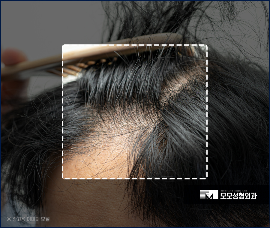 모발이식 삭발이 싫다면 노컷으로 부담을 줄여서 관련 이미지 6