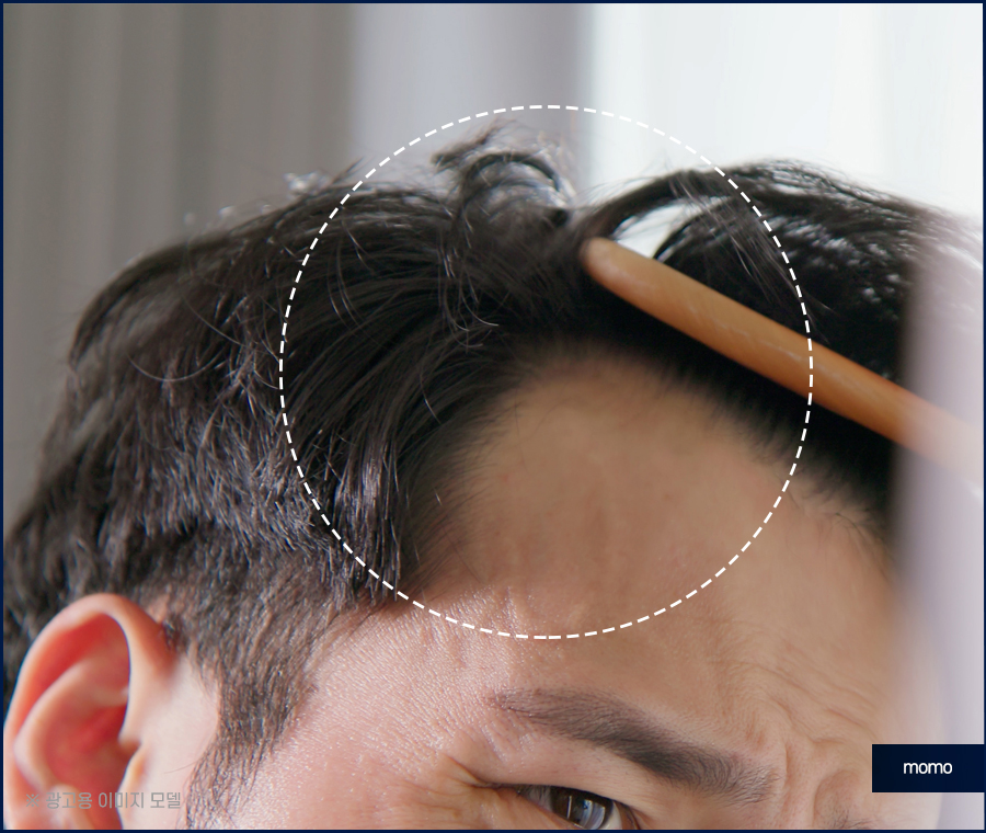 이마 머리 심기 넓은 모습을 보완하기 위한 관련 이미지 2