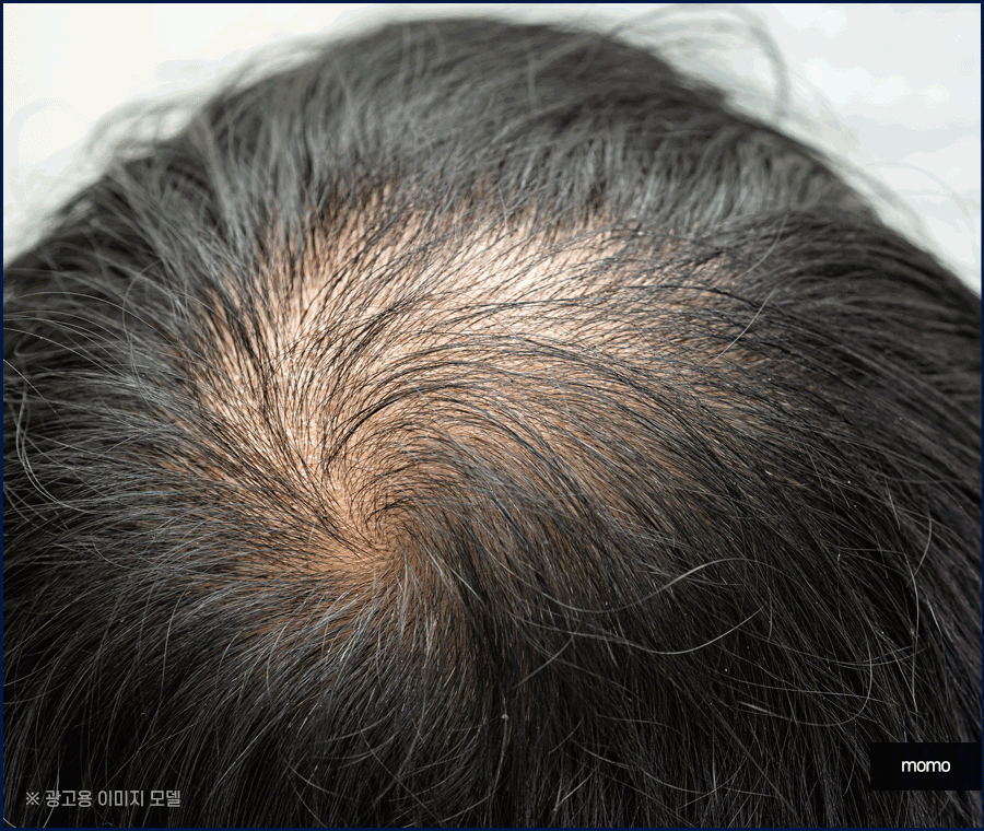 모발이식병원추천 개인에게 맞춰 진단하는 곳으로 관련 이미지 12