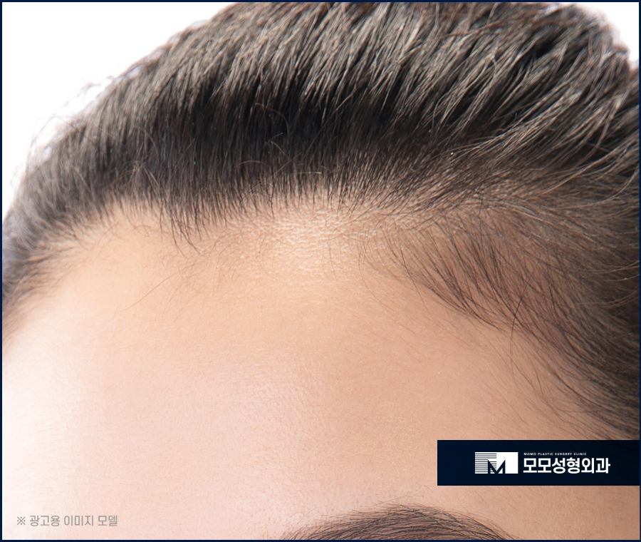 여자넓은이마 고민으로 부터 벗어나는 관련 이미지 2