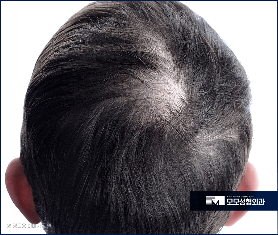 정수리탈모치료비용 모발이식을 기준으로 했을 땐 관련 이미지 2