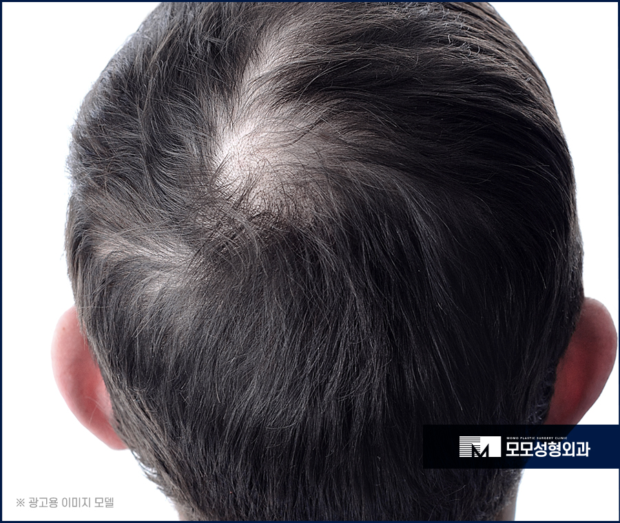 신사모발이식 단순히 채운다는 개념을 넘어 관련 이미지 5