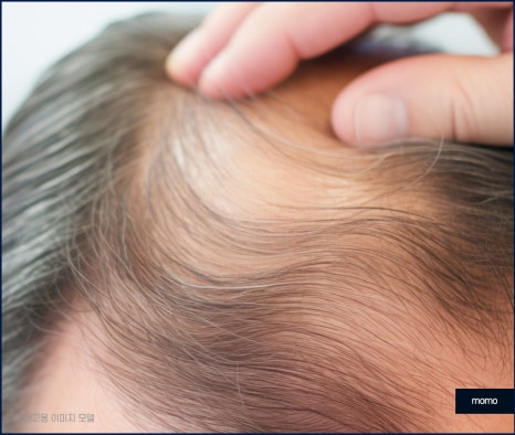 탈모약 부작용 증상 및 주의해야 할 사항 관련 이미지 2