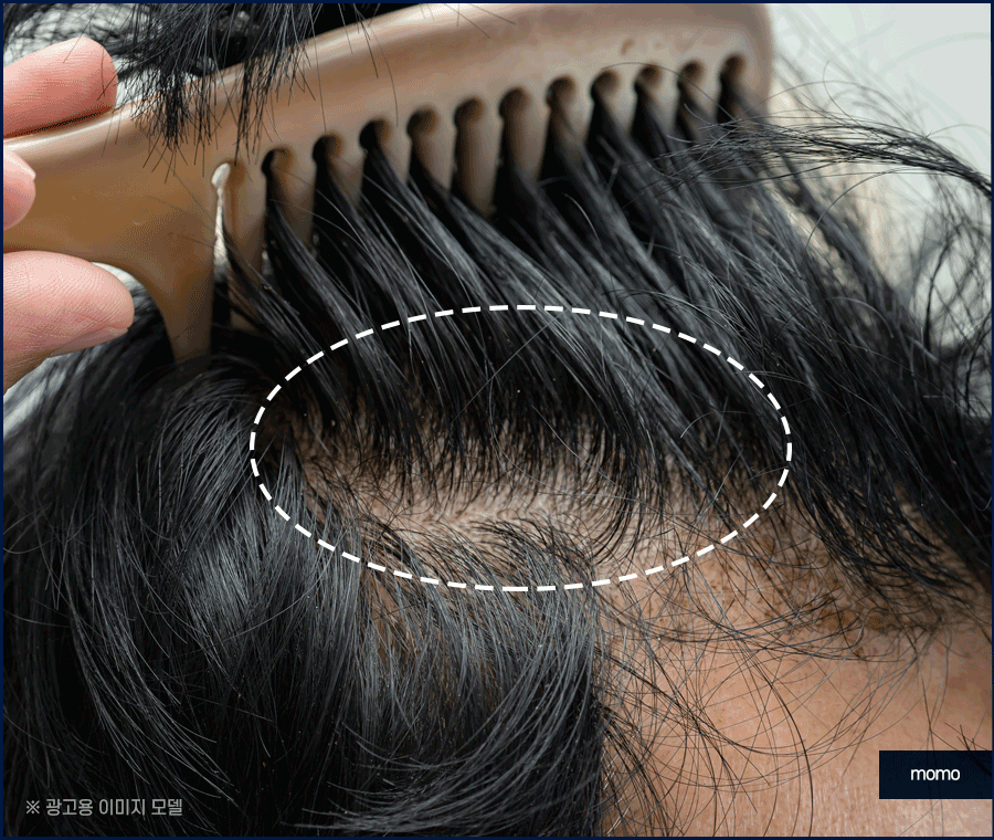 m자탈모병원 모발이식 고민이신 분들이라면 필독 관련 이미지 7