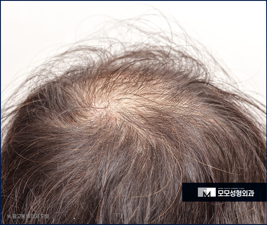 압구정모발이식병원 우수한 결과를 기대한다면 관련 이미지 2