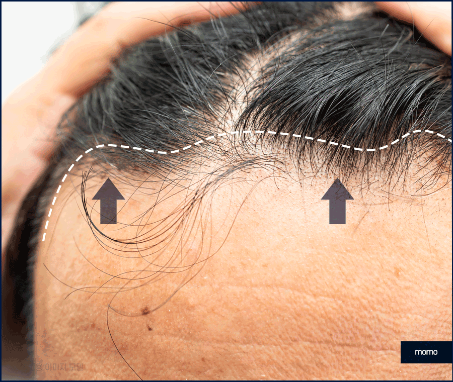 압구정 헤어라인 모발이식 라인 디자인으로 높인 완성도 관련 이미지 7