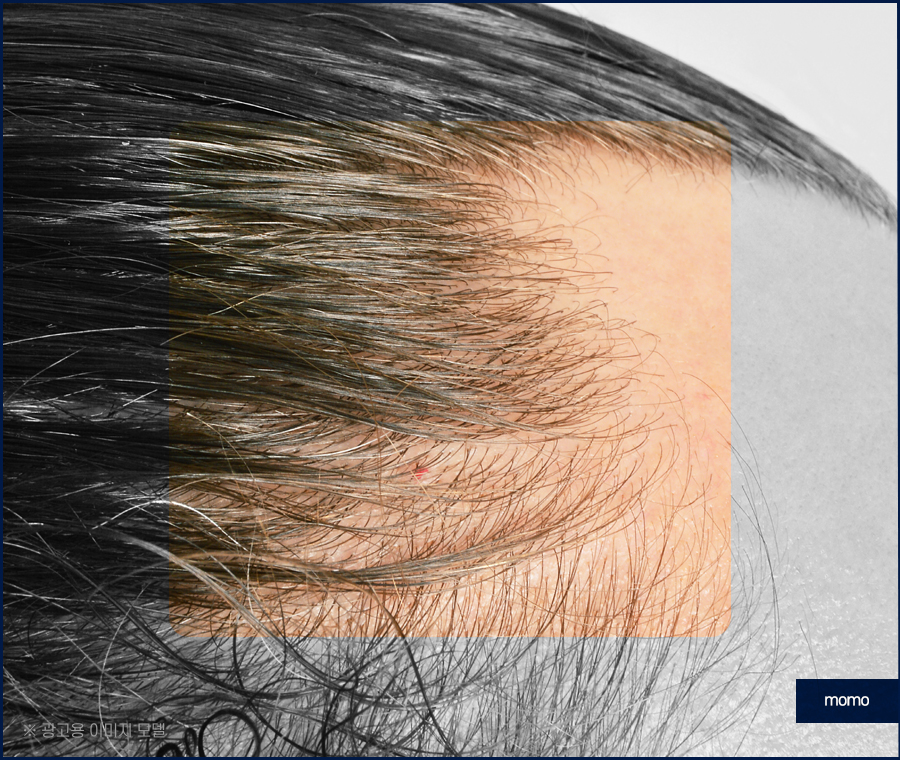 여자 M자 탈모 자연스럽게 채워가는 관련 이미지 9