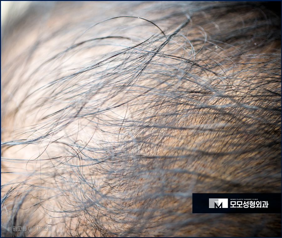 절개모발이식병원 생착률까지 생각해서 관련 이미지 3