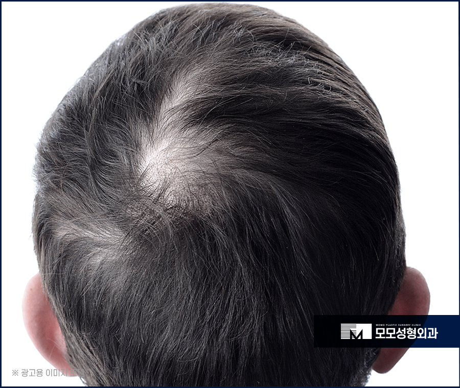 윗머리탈모 촘촘히 채워 고민을 탈출하는 관련 이미지 4
