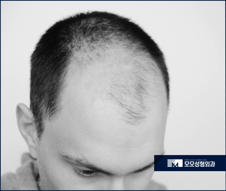 연예인모발이식 성공적인 변화를 위해서 관련 이미지 3