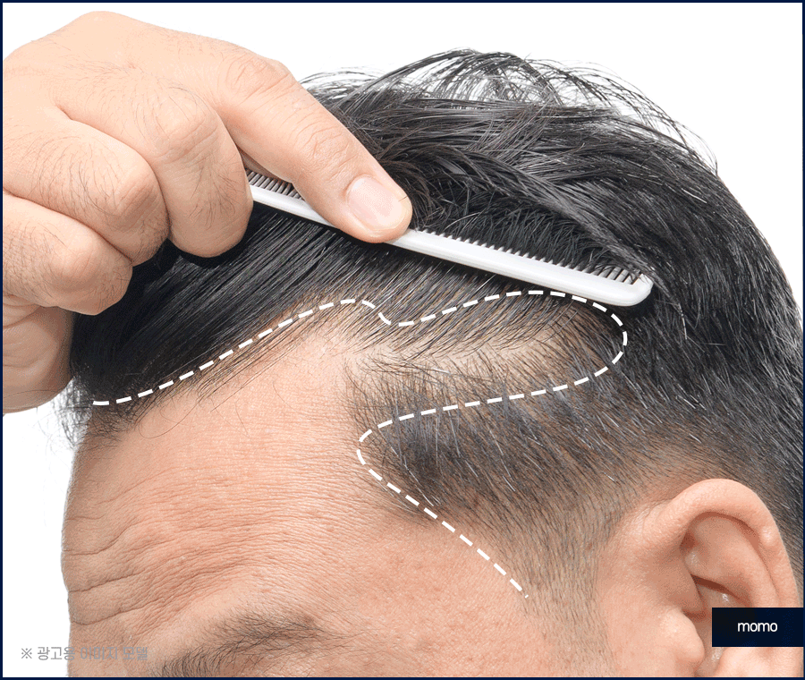 엠자이마 탈모 헤어라인 모발이식으로 관리하기 관련 이미지 5