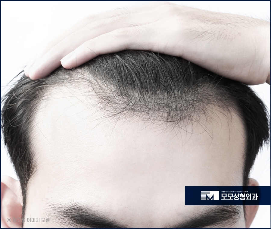 M자모발이식가격 충분한 보강을 원한다면 관련 이미지 3