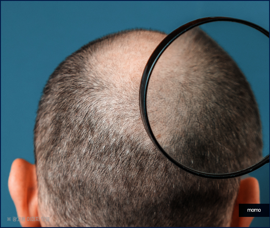 20대 원형탈모 효과적인 개선 방법은 관련 이미지 6