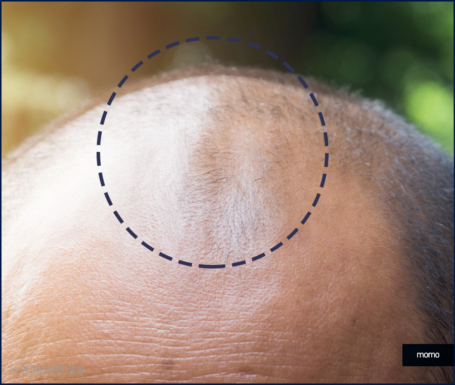 비절개 모발이식 비용 무삭발로 회복까지 빠르게 관련 이미지 7