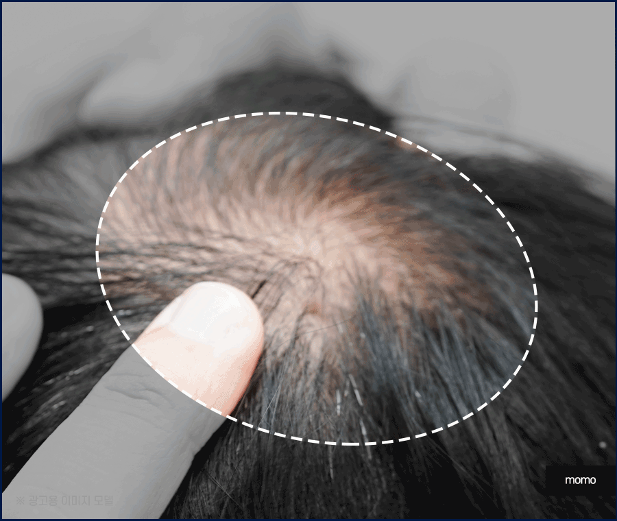 모발이식 3000모 비용 차이나는 이유 및 방법 관련 이미지 10