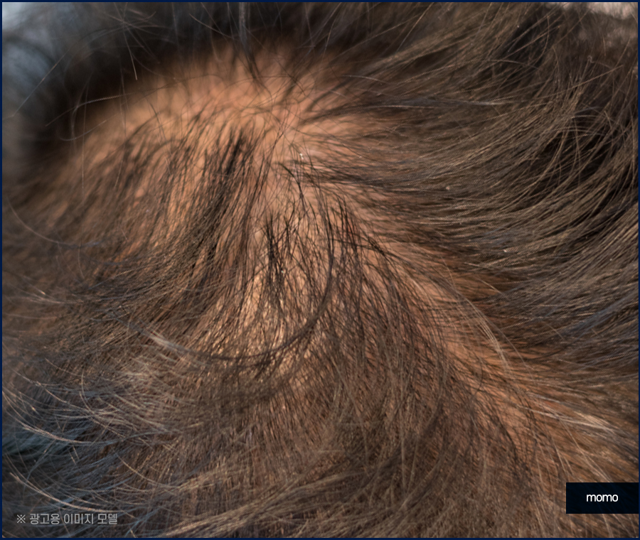 압구정역 모발이식 방법 및 생착률을 높이는 팁 관련 이미지 10