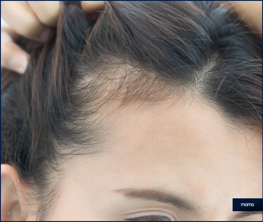 M자모발이식비용 가격 탈모 탈출을 위한 관련 이미지 10