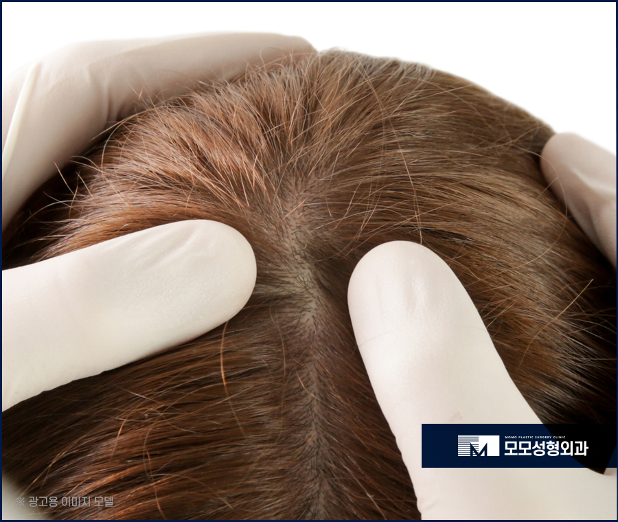 두피 피지낭종으로 인해 발생할 수 있는 문제들 관련 이미지 7
