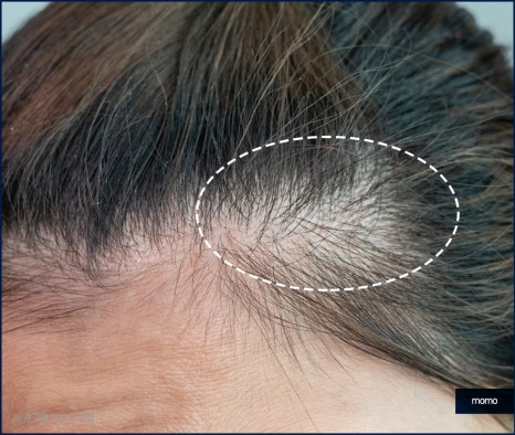 여자 m자 이마 헤어라인 모발이식으로 교정 관련 이미지 8