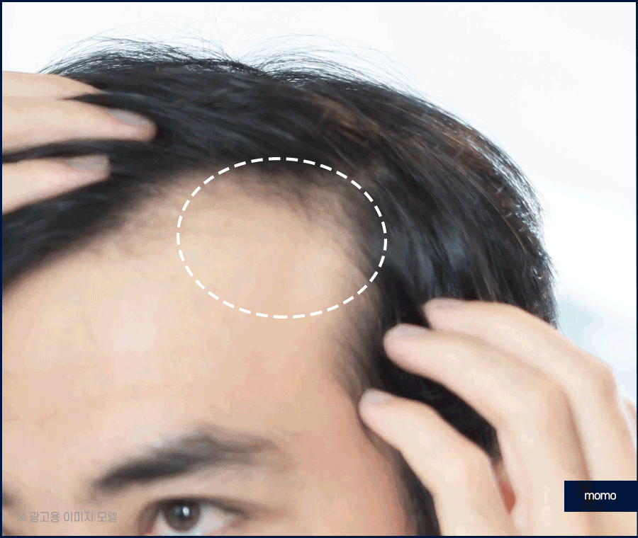 남자 모발이식 비용, 방법까지 꼼꼼히 확인하세요! 관련 이미지 12