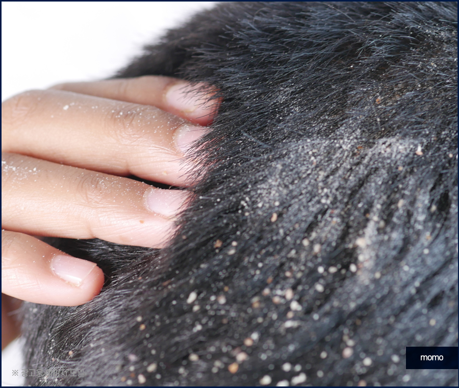 머리 비듬 생기는 이유부터 제거하는 효과적인 방법 관련 이미지 2