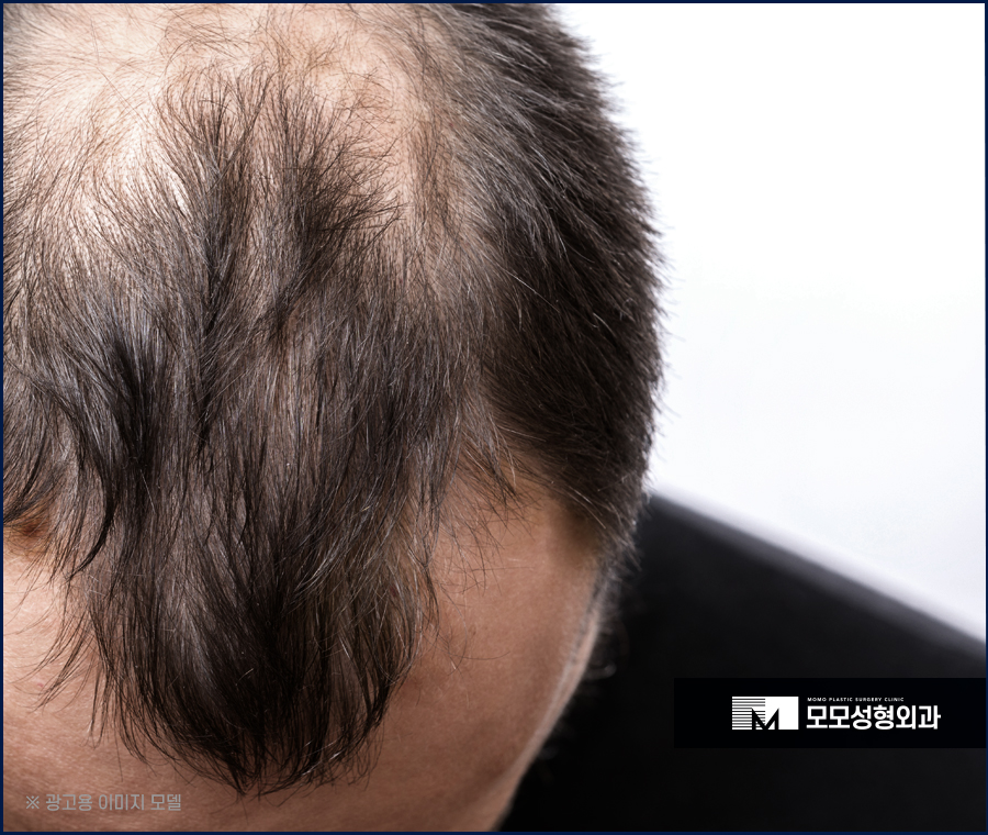 비절개모발이식 비용 넘쳐나는 자신감까지 만드는 관련 이미지 3