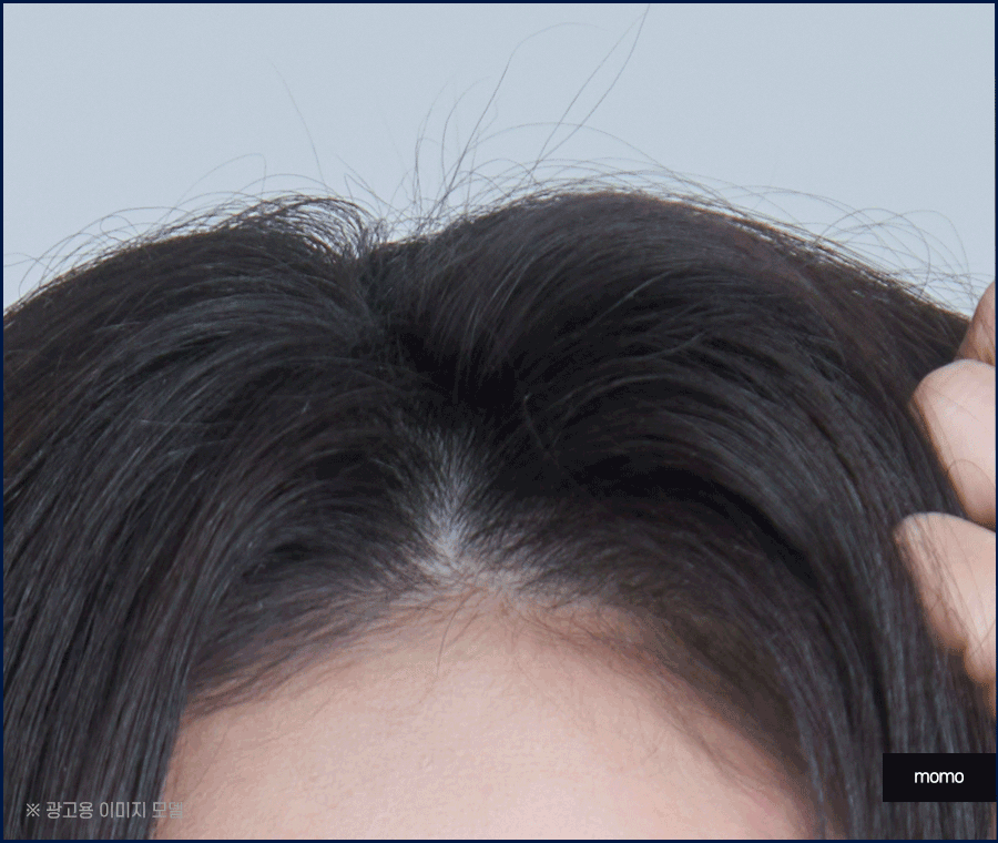 머리 감아도 비듬이 나타나는 이유 및 제거 팁 관련 이미지 2