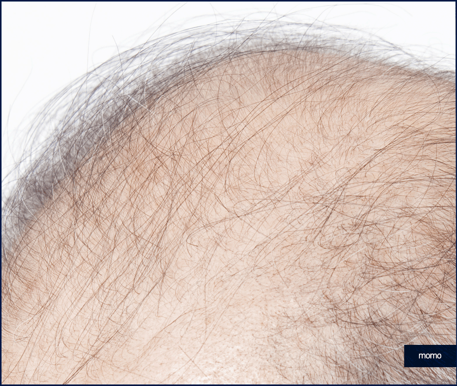 모발이식재수술 원인 및 성공을 위한 핵심 2가지 관련 이미지 7