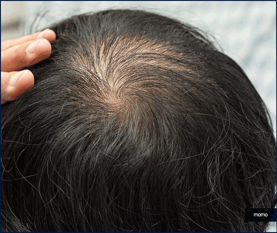 모발이식 금액 개인마다 차이가 나는 이유 관련 이미지 8