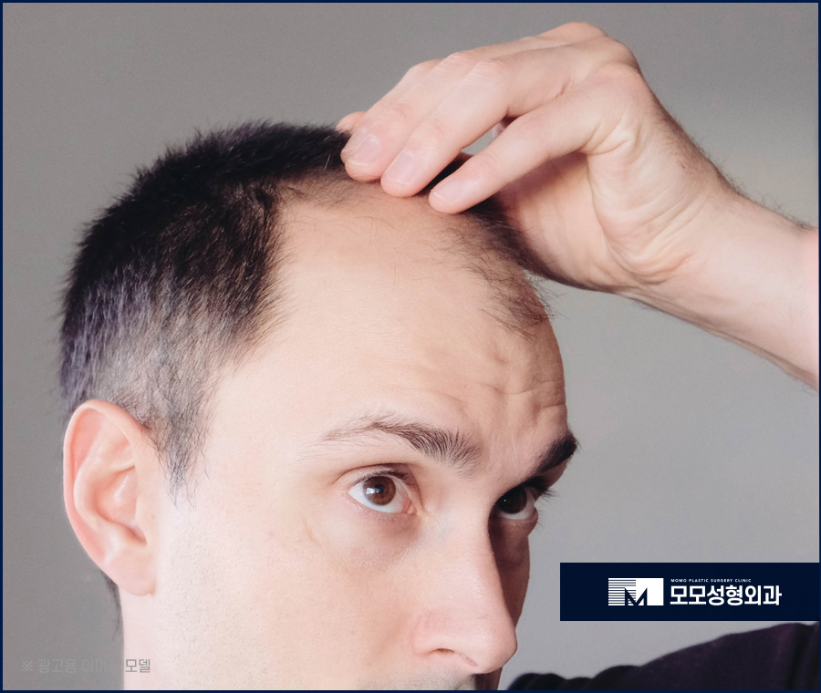 지루성두피염증상 어떤 것들이 있는지 관련 이미지 3