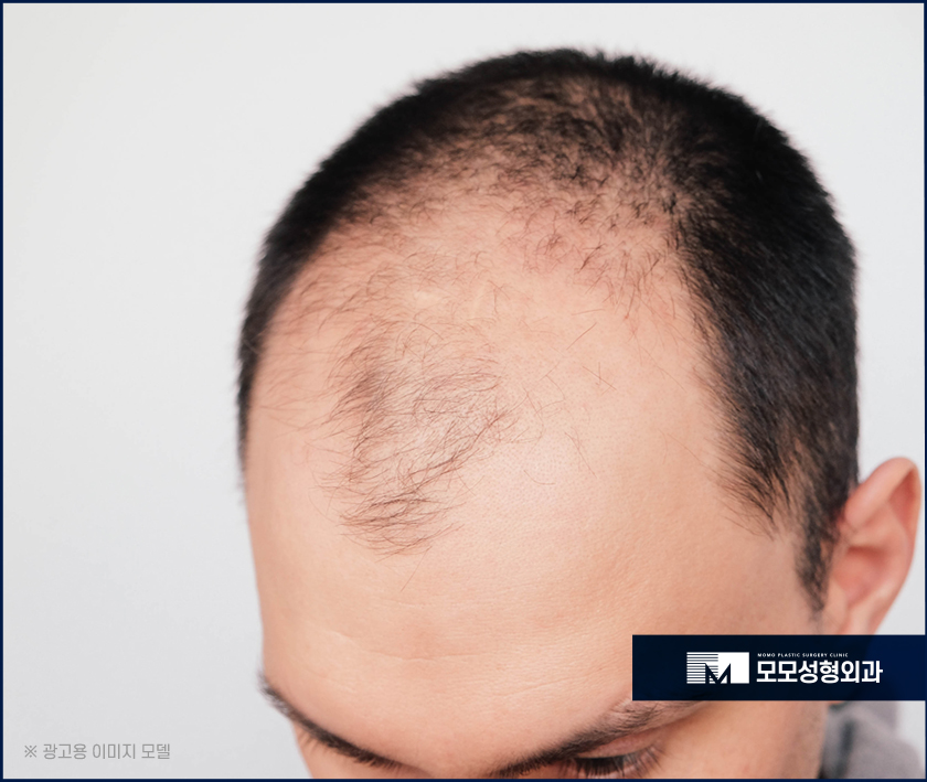 엠자이마를 그대로 두지 말아야하는 원인은 관련 이미지 5