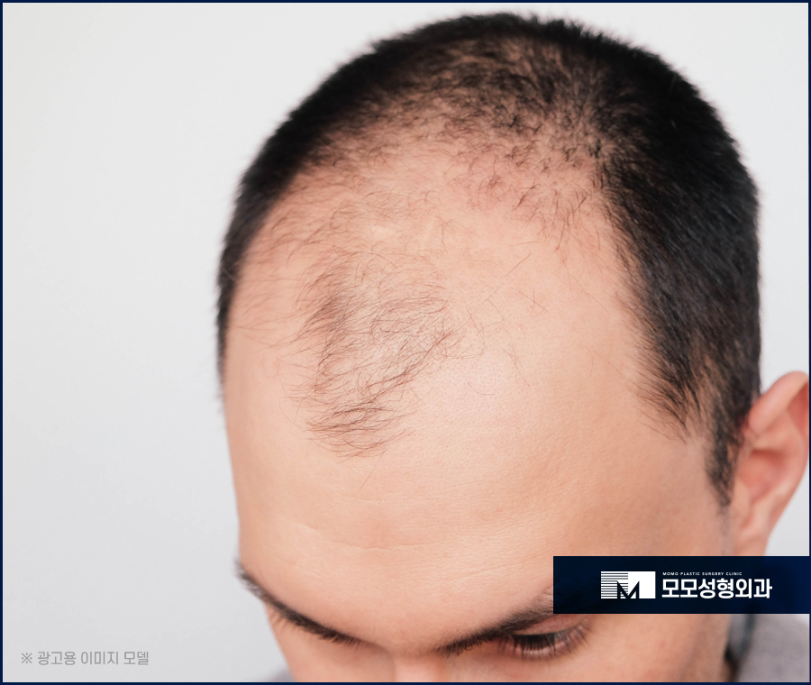모발이식땀 나는 일은 생착률에 어떤 영향을 미칠까 관련 이미지 2