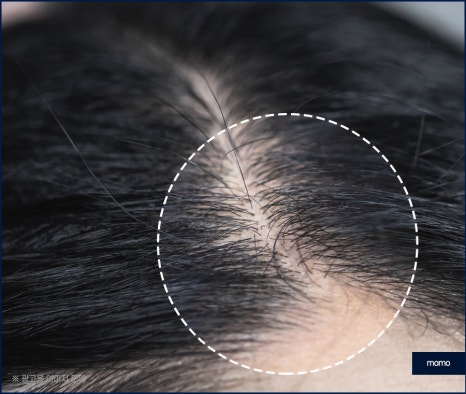 압구정 모발이식 외모 변화를 희망한다면 관련 이미지 2