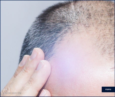 두피가 아파요 증상 원인과 해결하는 방안은 관련 이미지 4