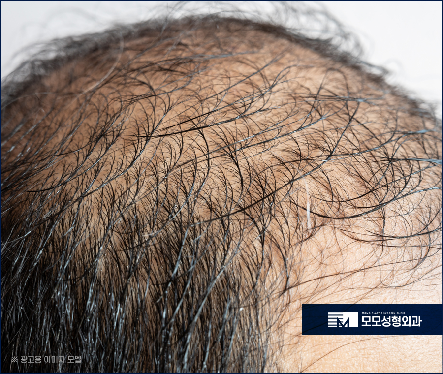 모발이식5000모 상태에 맞는 진단으로 관련 이미지 4