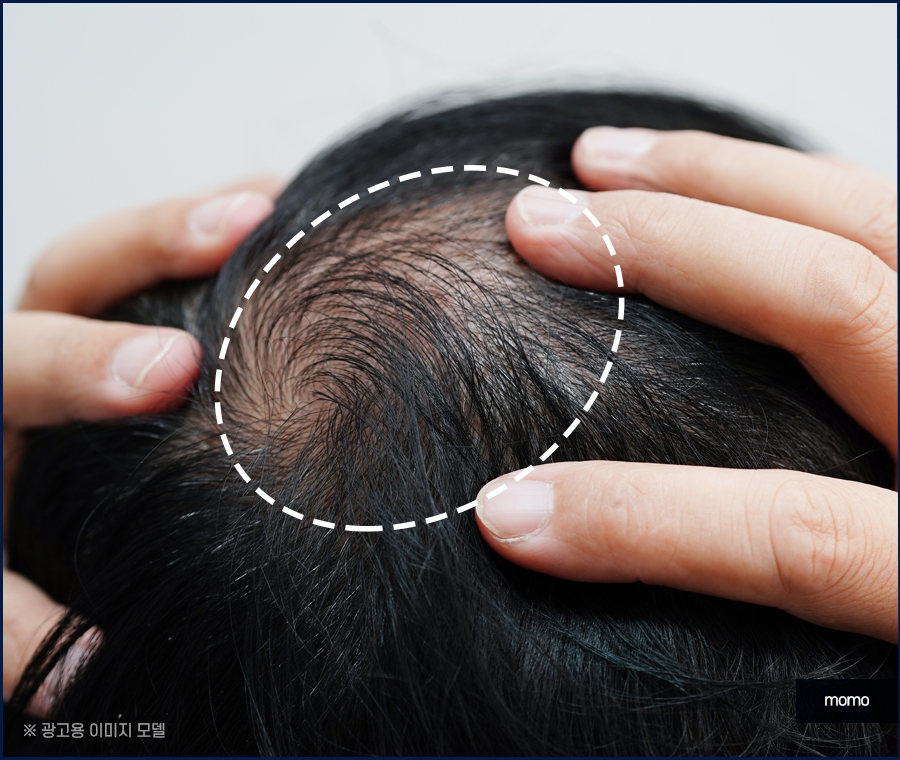 정수리 탈모 모발이식 섬세하게 채워가는 관련 이미지 8