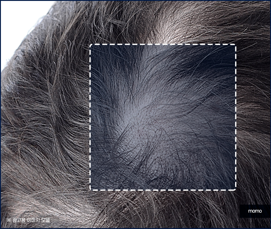 압구정 모발이식 탈모 문제를 해소하는 관련 이미지 10