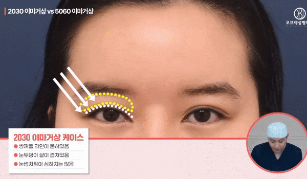 Can the Effects of Forehead Lift Surgery Change Even OO? How It Differs from Double Eyelid Surgery! image 3