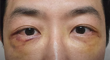 듀얼하안검 후기, 수술당일부터 69일까지 생생보고 #오브제성형외과 장욱원장님 관련 이미지 11
