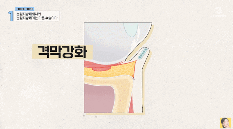 눈밑지 재발 이유? 세 가지만 알면 눈밑지방재배치 성공할 수 있어요! 관련 이미지 5