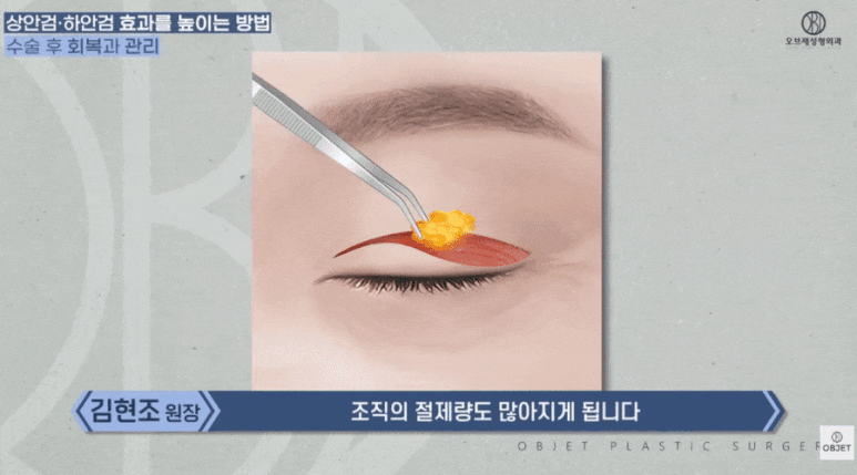 쌍수 붓기 안빠짐? 빨리 빼는 TIP! &ndash; 김현조 원장님 정리 관련 이미지 3