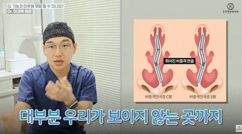 기능코성형 후 재발할 수 있다? 이경묵 원장님의 <Q&A> 관련 이미지 4