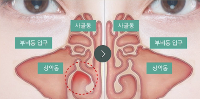 Nasal Surgery for Rhinitis: You Should Choose a Clinic That Knows ‘This’ Well! image 5