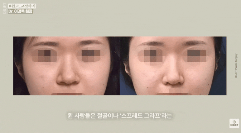 휜코 교정술 안 되는 코? 이경묵 원장님의 <기준 정리> 관련 이미지 4