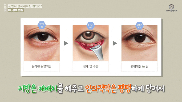 눈밑지방재배치 유지기간 성형외과 의사가 밝히는 2가지 진실! 관련 이미지 9