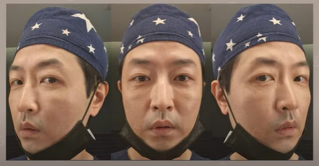 듀얼하안검 후기, 수술당일부터 69일까지 생생보고 #오브제성형외과 장욱원장님 관련 이미지 18