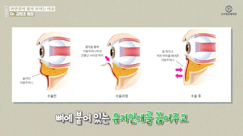 50대 하안검수술후기, 동안 효과는 여기서 갈린다고요? 관련 이미지 9