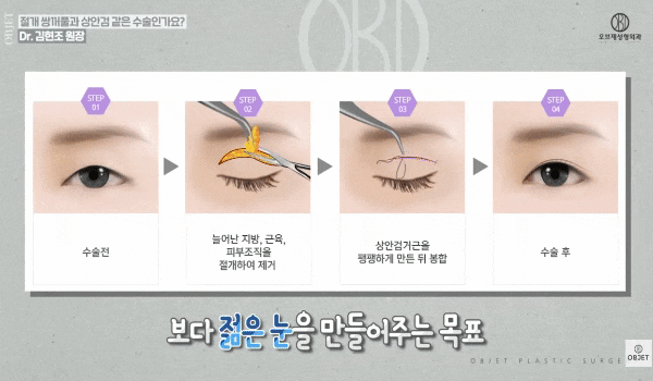 Middle-Aged Double-Eyelid Surgery vs. Upper Blepharoplasty: What’s the Difference? <Differences> Summarized! image 6