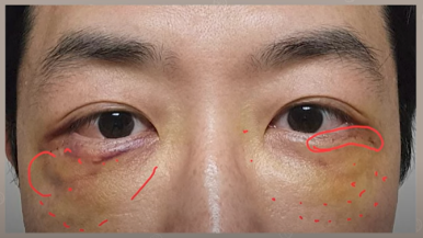 듀얼하안검 후기, 수술당일부터 69일까지 생생보고 #오브제성형외과 장욱원장님 관련 이미지 12